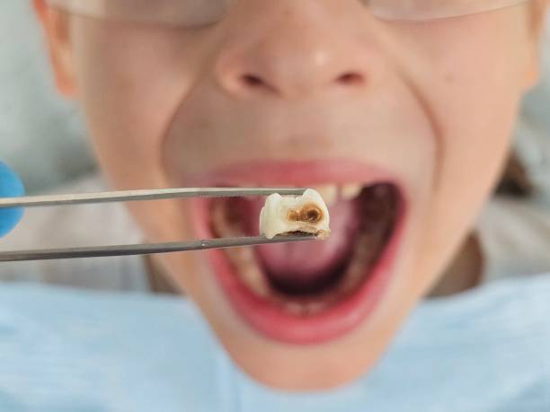 Best Emergency Dental Extractions in Antlers, OK